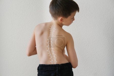 nackter Rücken des Jungen, Kind im Alter von 8-10 Jahren gebeugt von Rückenschmerzen, gekrümmte Wirbelsäule, Schmerzen in der Wirbelsäule, Konzept der therapeutischen Massage bei Osteochondrose, Skoliose, Rückenschmerzen, Bandscheibenvorfall