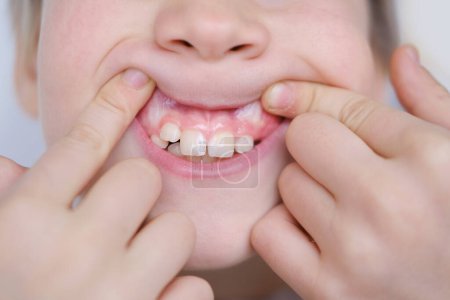 Junge lächelnde Kinder, Junge, Alter 10 zeigt wachsende Zähne, markiert Meilenstein in der zahnärztlichen Entwicklung, Kinderzahngesundheit, Stadium des Zahnausbruchs