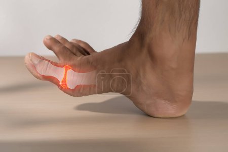 Photo for Gout or inflammatory arthritis in a men. High uric acid. - Royalty Free Image