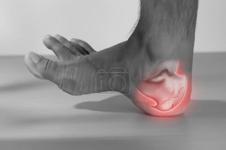 A man has a heel injury because his heel bone is broken.