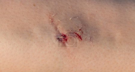 Photo for A wound on the body. Skin regeneration. Limb injury. Scratched knee. - Royalty Free Image