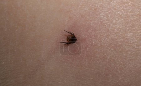 Photo for Ixodes ricinus, the castor bean tick. The parasite during the bite. Carrier Lyme disease and tick-borne encephalitis on the human skin. Male. - Royalty Free Image