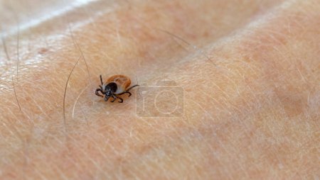 Photo for A predatory parasitic tick crawls along the human body. Selective focus. - Royalty Free Image