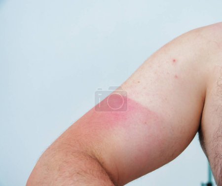 Photo for Man with red sunburned skin against light background closeup - Royalty Free Image