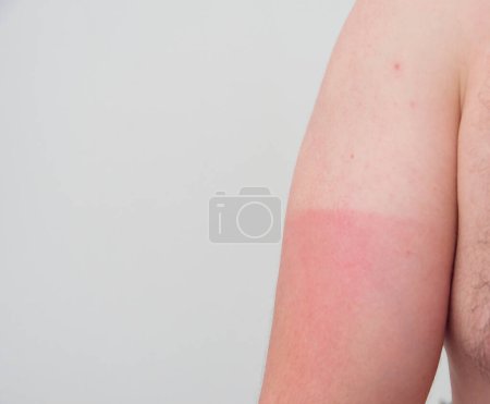 Photo for Man with red sunburned skin against light background closeup - Royalty Free Image