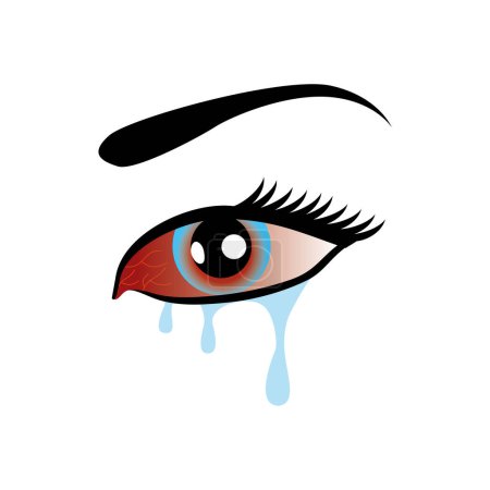 Augengrippe, rote Augen, Rötung des Auges, Bindehautentzündung.