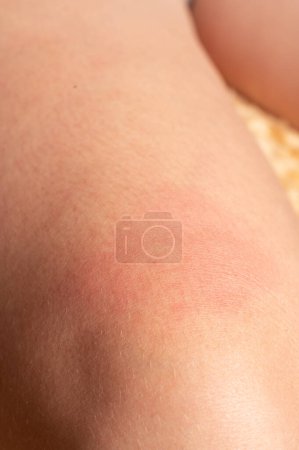 Photo for Allergy on human body and redness from wasp sting, redness and sting close-up. - Royalty Free Image