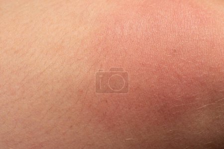 Téléchargez les photos : Allergie sur le corps humain et rougeur due à la piqûre de guêpe, rougeur et piqûre gros plan. - en image libre de droit