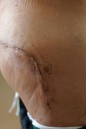 Foto de Cicatriz tras cirugía de reemplazo articular en cadera - Imagen libre de derechos