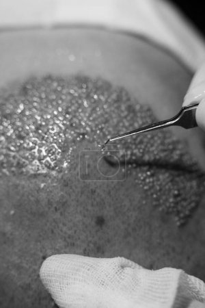 Photo for Hair transplant dhi and fue system. Super macro close hair scalp. Super macro hair gratfs - Royalty Free Image
