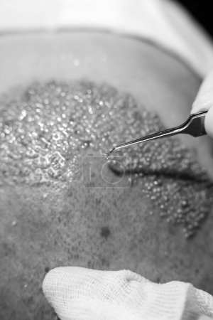 Photo for Hair transplant dhi and fue system. Super macro close hair scalp. Super macro hair gratfs - Royalty Free Image