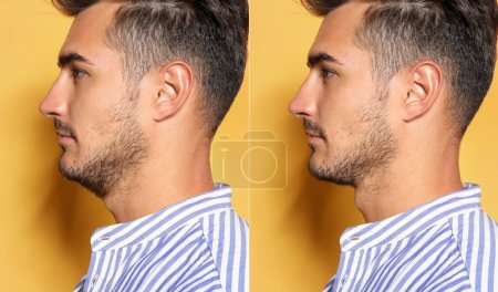 Doppelkinn-Problem. Collage mit Fotos von Menschen vor und nach Schönheitsoperationen auf gelbem Hintergrund