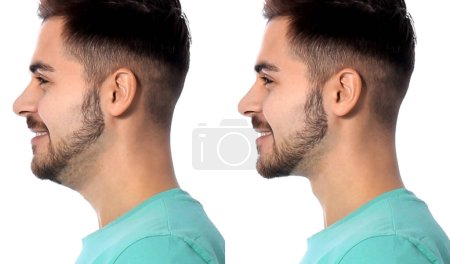Double chin problem. Collage with photos of man before and after plastic surgery procedure on white background