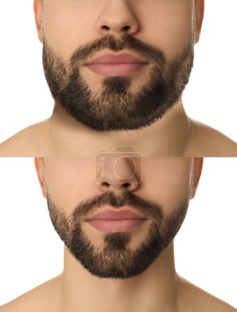 Photo for Double chin problem. Collage with photos of man before and after plastic surgery procedure on white background, closeup - Royalty Free Image
