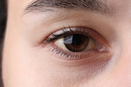 Frau mit gelben Augen, Nahaufnahme. Symptom einer Hepatitis