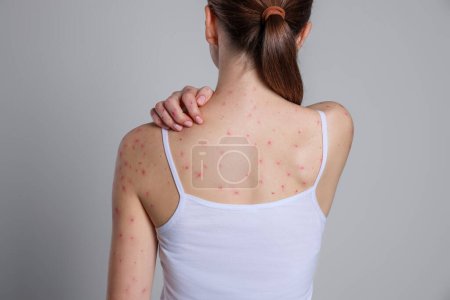 Téléchargez les photos : Femme avec éruption cutanée souffrant du virus de la variole du singe sur fond gris clair, vue de dos - en image libre de droit
