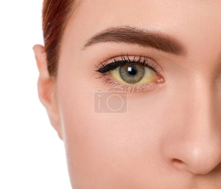 Mujer con ojos amarillos sobre fondo blanco, primer plano. Síntoma de hepatitis
