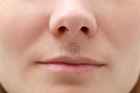 Photo for Woman with dry skin, closeup of mouth - Royalty Free Image