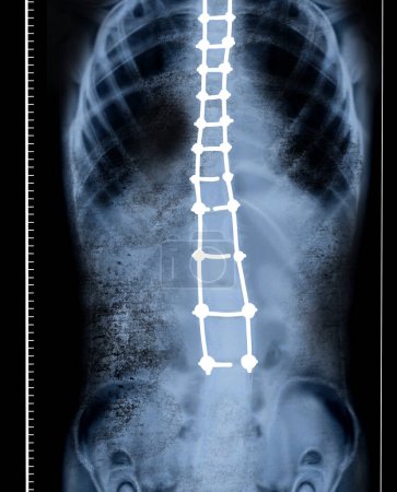 Photo for X-ray of human spine showing curvature. Patient suffering from scoliosis - Royalty Free Image