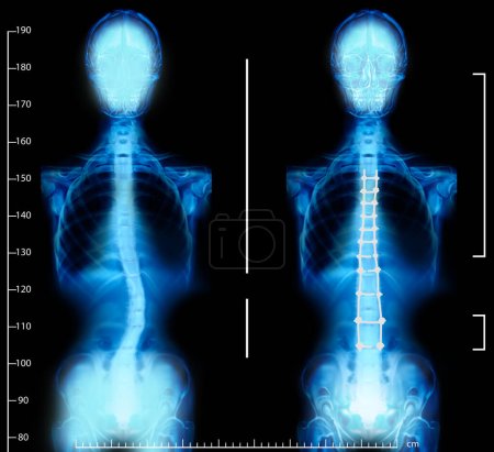 Téléchargez les photos : Rayons X des épines humaines normales et courbes. Patient atteint de scoliose - en image libre de droit