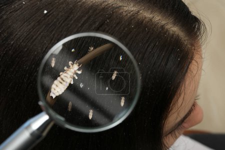 Photo for Pediculosis. Woman with lice and nits, closeup. View through magnifying glass on hair - Royalty Free Image