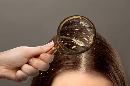 Photo for Pediculosis. Woman with lice and nits on grey background, closeup. View through magnifying glass on hair - Royalty Free Image