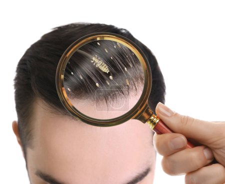 Photo for Pediculosis. Man with lice and nits on white background, closeup. View through magnifying glass on hair - Royalty Free Image