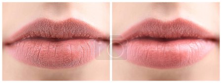 Téléchargez les photos : Collage avec des photos de femme avant et après l'utilisation du baume à lèvres, gros plan - en image libre de droit
