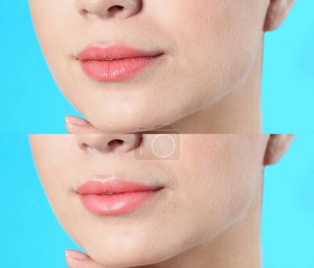 Téléchargez les photos : Collage avec des photos de femme avant et après l'utilisation du baume à lèvres sur fond bleu clair, gros plan - en image libre de droit