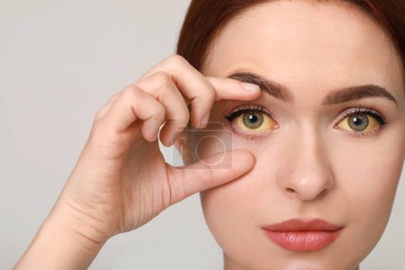 Woman with yellow eyes on light grey background. Symptom of hepatitis