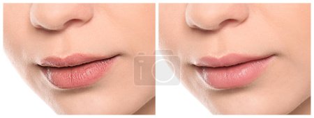 Téléchargez les photos : Collage avec des photos de femme avant et après l'utilisation du baume à lèvres sur fond blanc, gros plan - en image libre de droit