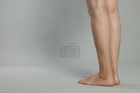 Photo for Closeup view of woman with varicose veins on light grey background. Space for text - Royalty Free Image