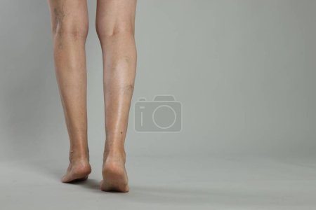 Closeup view of woman with varicose veins on light grey background. Space for text
