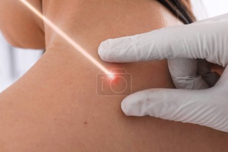 Téléchargez les photos : Laser mole removal. Doctor checking patient's skin during procedure in clinic, closeup - en image libre de droit
