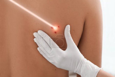 Photo for Laser mole removal. Doctor checking patient's skin during procedure on white background, closeup - Royalty Free Image