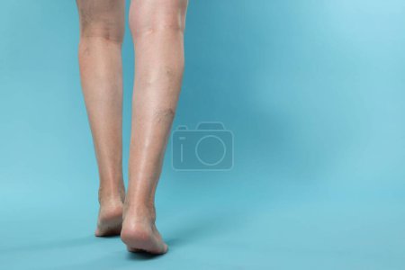 Photo for Closeup view of woman with varicose veins on light blue background. Space for text - Royalty Free Image