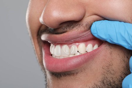 Foto de Dentista examinando las encías del hombre sobre fondo gris, primer plano - Imagen libre de derechos