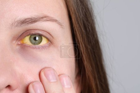 Woman with yellow eyes on light background, closeup. Symptom of hepatitis