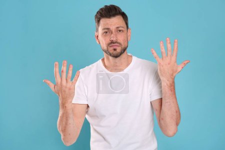 Man with rash suffering from monkeypox virus on light blue background