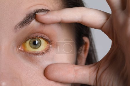 Foto de Mujer con ojos amarillos sobre fondo claro, primer plano. Síntoma de hepatitis - Imagen libre de derechos