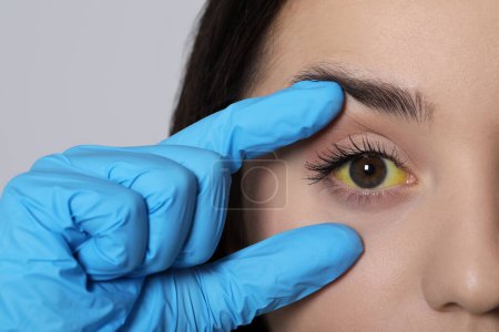 Doctor checking woman with yellow eyes on light background, closeup. Symptom of hepatitis