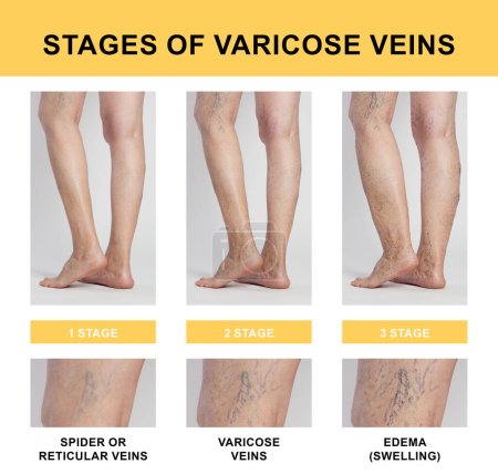 Photo for Stages of varicose veins. Photos of woman and zoomed skin area, closeup. Collage showing changes during different phases - Royalty Free Image