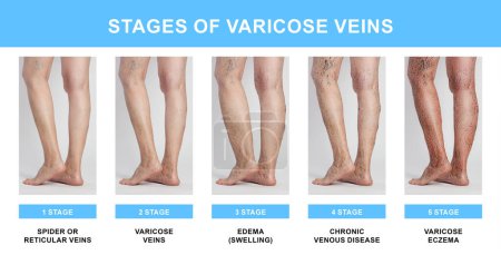Photo for Stages of varicose veins. Collage with photos of woman showing changes during different phases, closeup of legs - Royalty Free Image