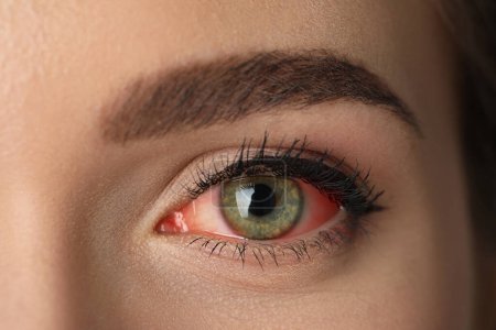 Frau leidet an Bindehautentzündung, Nahaufnahme eines roten Auges