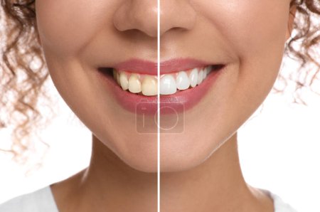 Photo for Photo of woman divided in halves before and after tooth whitening on white background, closeup. Collage design - Royalty Free Image