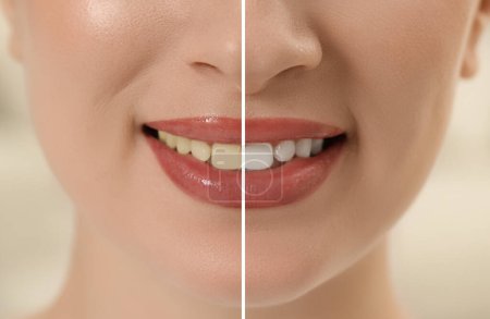 Foto de Foto de mujer dividida en mitades antes y después del blanqueamiento dental, primer plano. Diseño de collage - Imagen libre de derechos