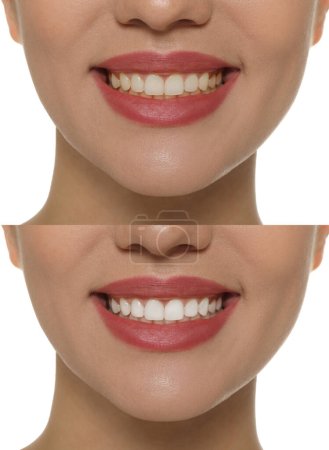 Foto de Collage con fotos de la mujer antes y después del blanqueamiento dental sobre fondo blanco, primer plano - Imagen libre de derechos