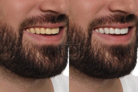 Foto de Collage con fotos del hombre antes y después del blanqueamiento dental, primer plano - Imagen libre de derechos