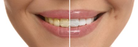 Photo for Photo of woman divided in halves before and after tooth whitening on white background, closeup. Collage design - Royalty Free Image
