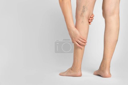 Photo for Closeup view of woman suffering from varicose veins on light background. Space for text - Royalty Free Image